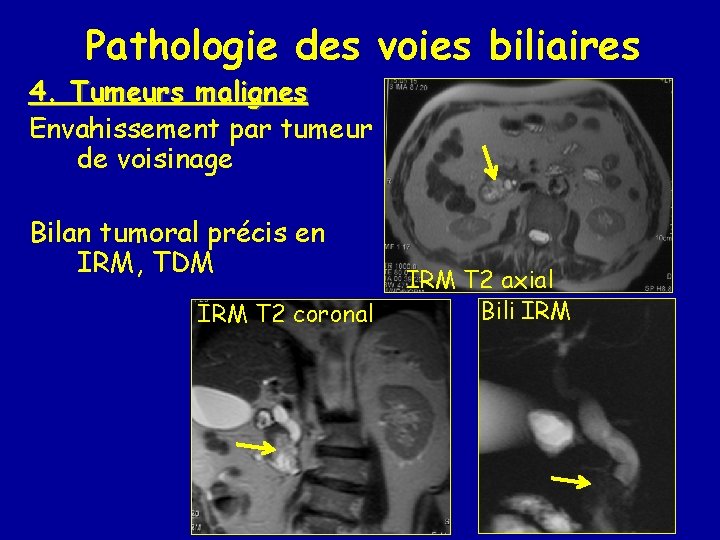 Pathologie des voies biliaires 4. Tumeurs malignes Envahissement par tumeur de voisinage Bilan tumoral