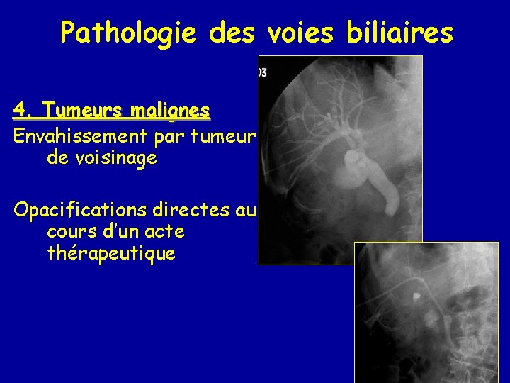 Pathologie des voies biliaires 4. Tumeurs malignes Envahissement par tumeur de voisinage Opacifications directes