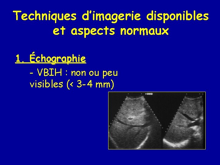Techniques d’imagerie disponibles et aspects normaux 1. Échographie - VBIH : non ou peu