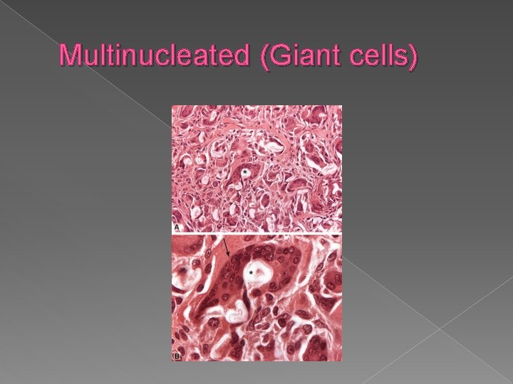 Multinucleated (Giant cells) 