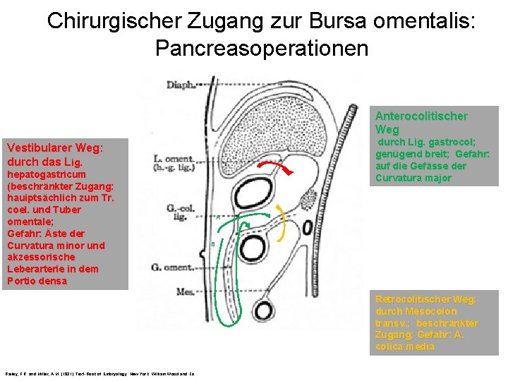 Chirurgischer Zugang zur Bursa omentalis: Pancreasoperationen Anterocolitischer Weg durch Lig. gastrocol; genügend breit; Gefahr: