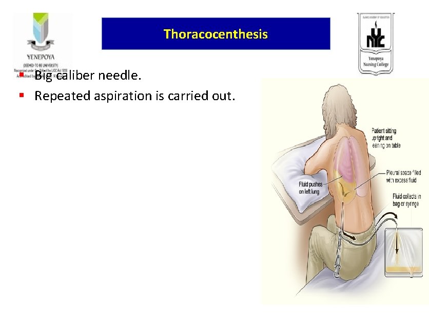 Thoracocenthesis § Big caliber needle. § Repeated aspiration is carried out. 