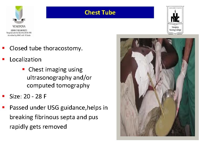 Chest Tube § Closed tube thoracostomy. § Localization § Chest imaging using ultrasonography and/or