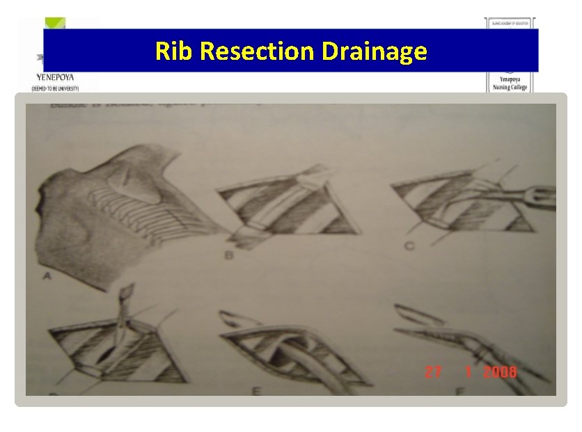 Rib Resection Drainage 