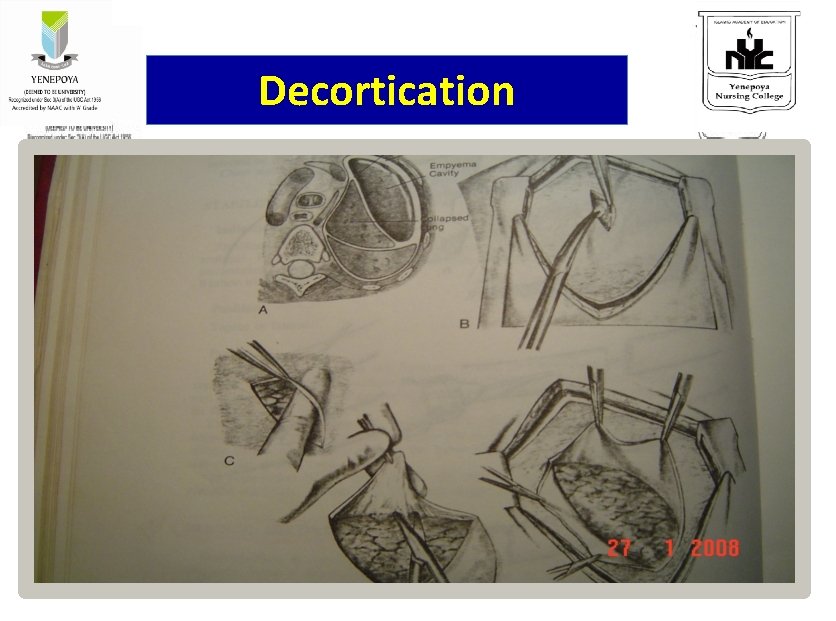 Decortication 