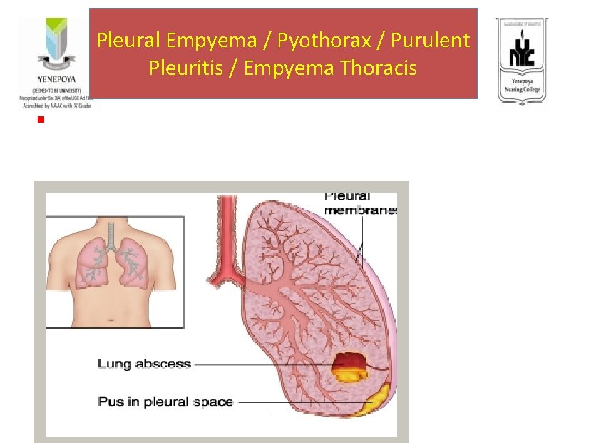 Pleural Empyema / Pyothorax / Purulent Pleuritis / Empyema Thoracis § Accumulation of Pus