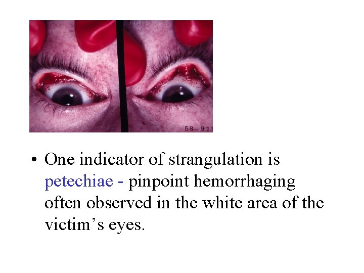  • One indicator of strangulation is petechiae - pinpoint hemorrhaging often observed in