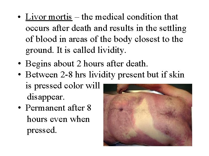  • Livor mortis – the medical condition that occurs after death and results