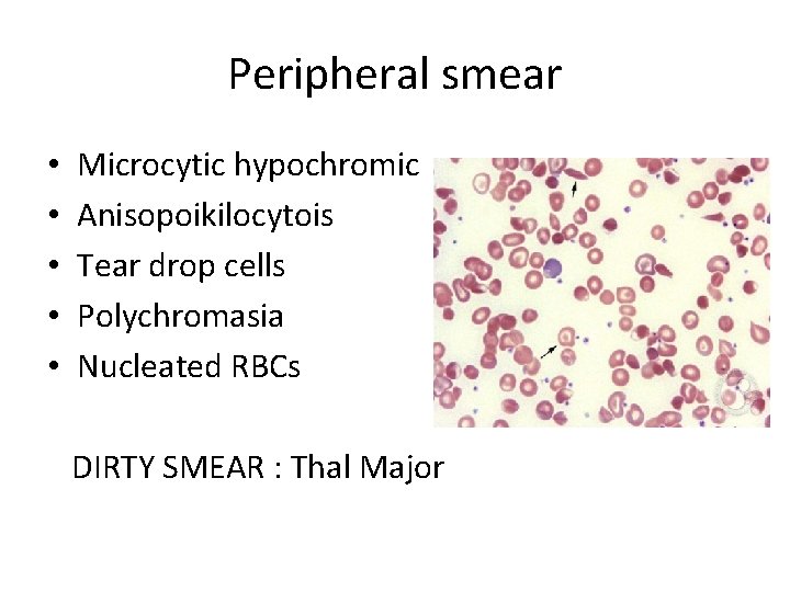 Peripheral smear • • • Microcytic hypochromic Anisopoikilocytois Tear drop cells Polychromasia Nucleated RBCs