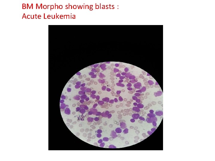 BM Morpho showing blasts : Acute Leukemia 