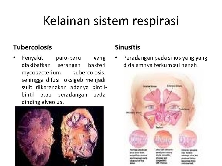 Kelainan sistem respirasi Tubercolosis Sinusitis • Penyakit paru-paru yang diakibatkan serangan bakteri mycobacterium tubercolosis.