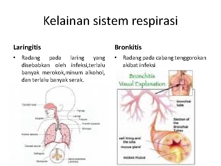 Kelainan sistem respirasi Laringitis Bronkitis • Radang pada laring yang disebabkan oleh infeksi, terlalu