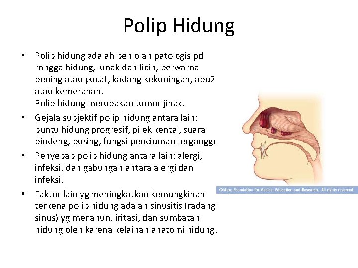 Polip Hidung • Polip hidung adalah benjolan patologis pd rongga hidung, lunak dan licin,