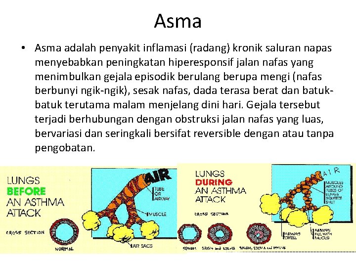 Asma • Asma adalah penyakit inflamasi (radang) kronik saluran napas menyebabkan peningkatan hiperesponsif jalan