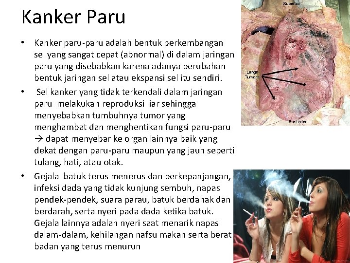 Kanker Paru • Kanker paru-paru adalah bentuk perkembangan sel yang sangat cepat (abnormal) di