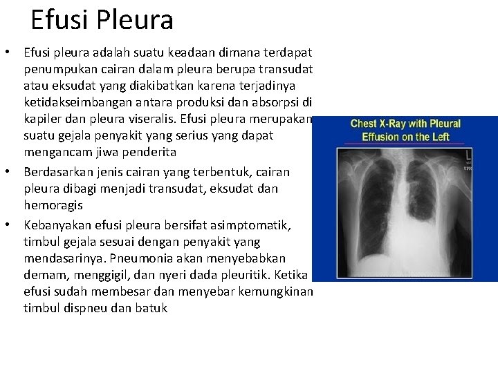 Efusi Pleura • Efusi pleura adalah suatu keadaan dimana terdapat penumpukan cairan dalam pleura