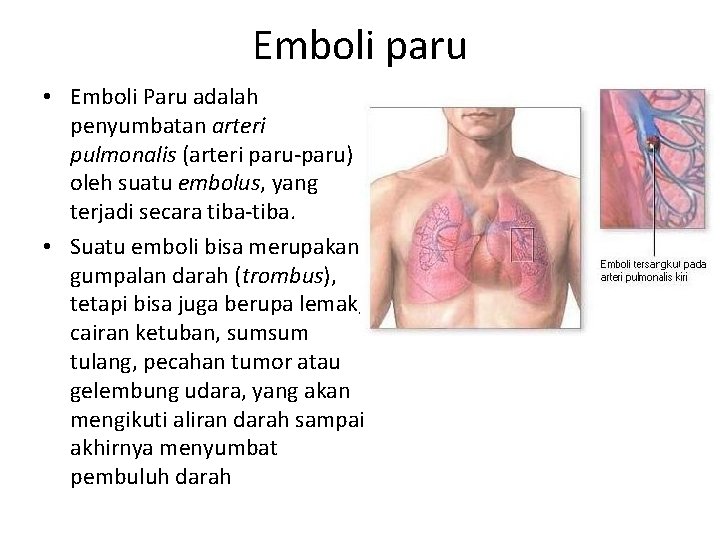 Emboli paru • Emboli Paru adalah penyumbatan arteri pulmonalis (arteri paru-paru) oleh suatu embolus,