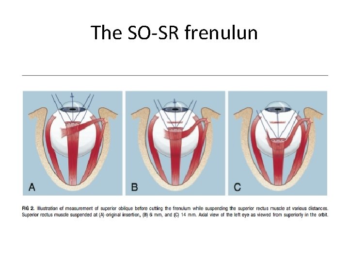 The SO-SR frenulun 