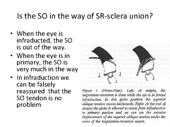 Is the SO in the way of SR-sclera union? • When the eye is
