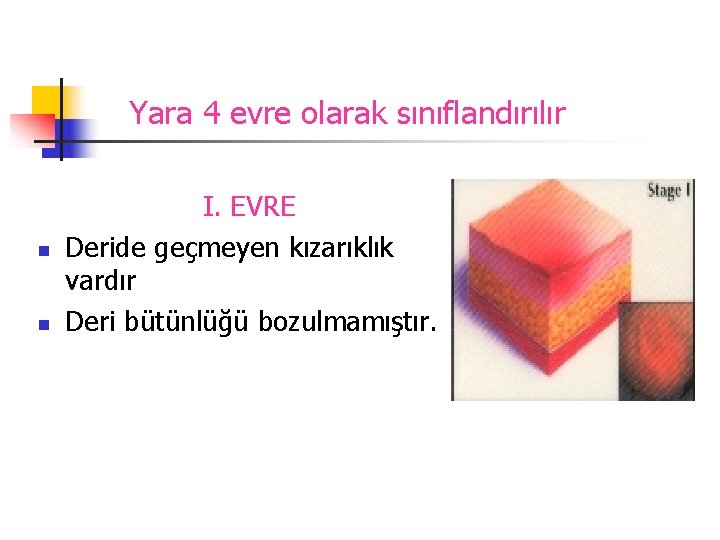 Yara 4 evre olarak sınıflandırılır n n I. EVRE Deride geçmeyen kızarıklık vardır Deri