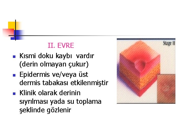 n n n II. EVRE Kısmi doku kaybı vardır (derin olmayan çukur) Epidermis ve/veya