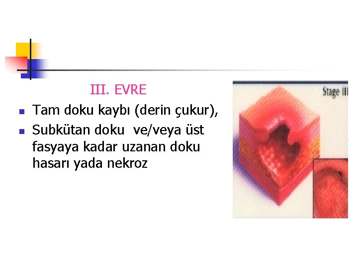 n n III. EVRE Tam doku kaybı (derin çukur), Subkütan doku ve/veya üst fasyaya