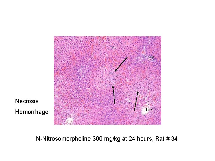 PP Necrosis Hemorrhage THV N-Nitrosomorpholine 300 mg/kg at 24 hours, Rat # 34 