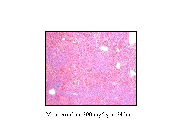 Monocrotaline 300 mg/kg at 24 hrs 