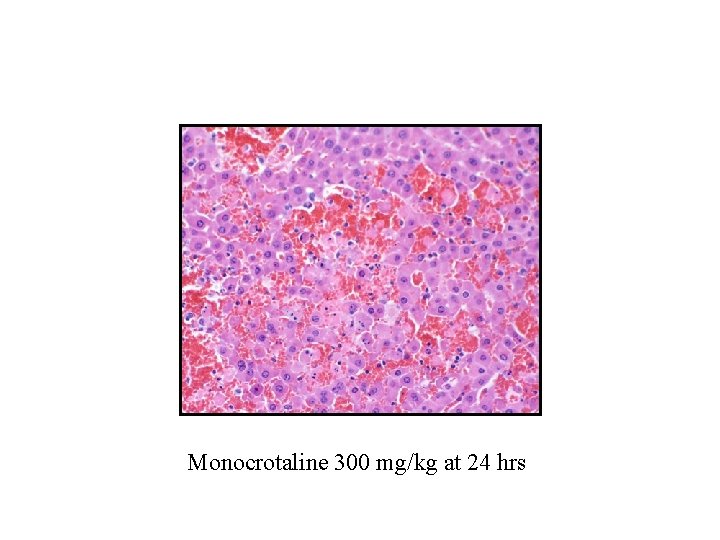 Monocrotaline 300 mg/kg at 24 hrs 