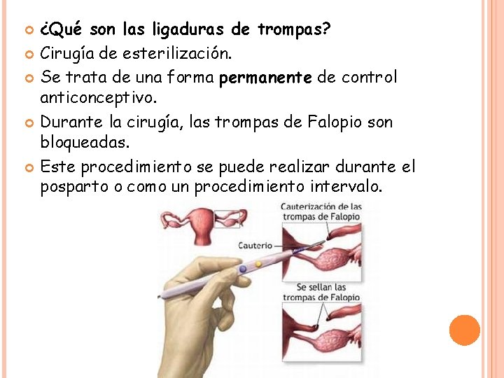 ¿Qué son las ligaduras de trompas? Cirugía de esterilización. Se trata de una forma