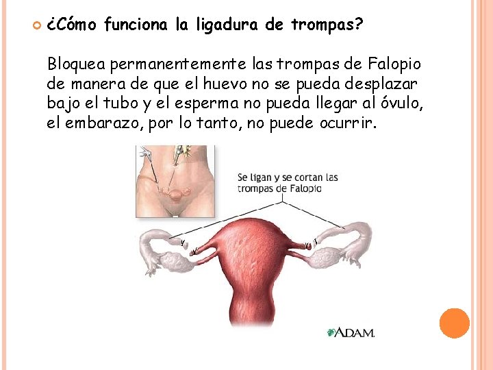  ¿Cómo funciona la ligadura de trompas? Bloquea permanentemente las trompas de Falopio de
