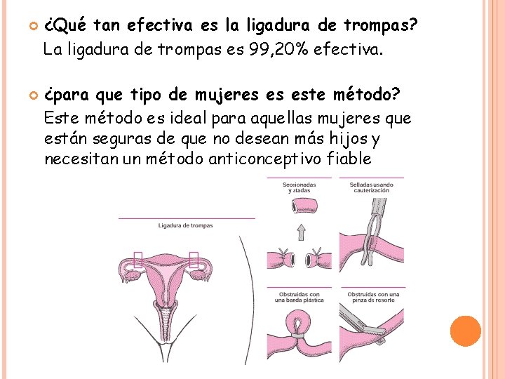  ¿Qué tan efectiva es la ligadura de trompas? La ligadura de trompas es