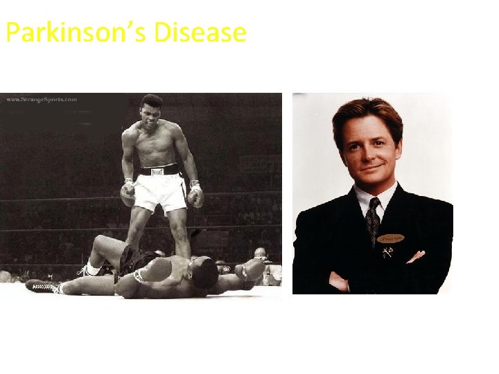 Parkinson’s Disease 