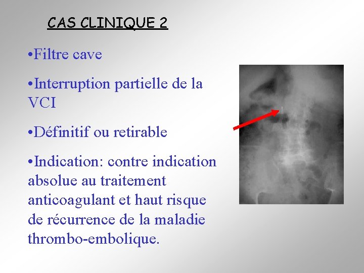 CAS CLINIQUE 2 • Filtre cave • Interruption partielle de la VCI • Définitif