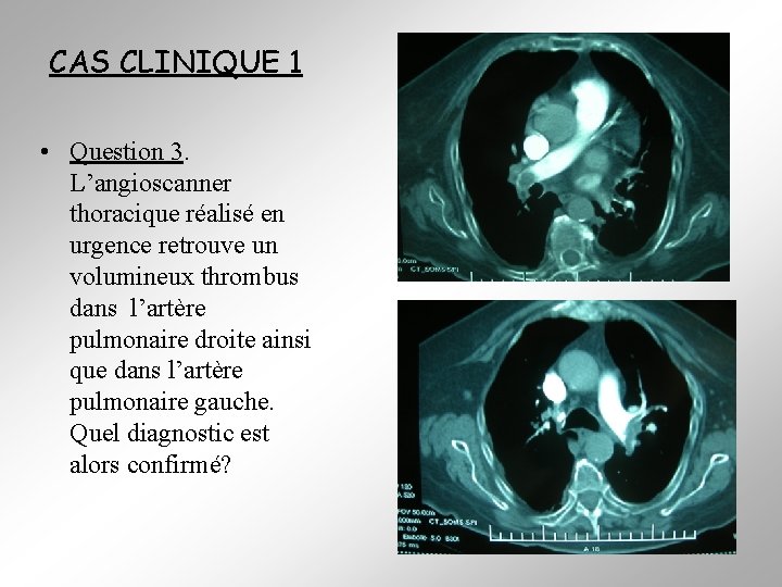 CAS CLINIQUE 1 • Question 3. L’angioscanner thoracique réalisé en urgence retrouve un volumineux