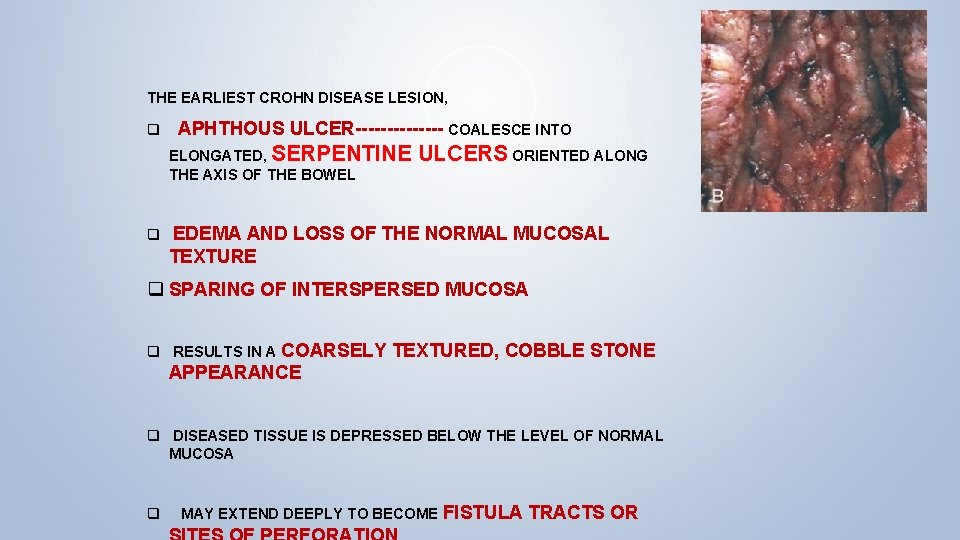 THE EARLIEST CROHN DISEASE LESION, q APHTHOUS ULCER------- COALESCE INTO ELONGATED, SERPENTINE ULCERS ORIENTED