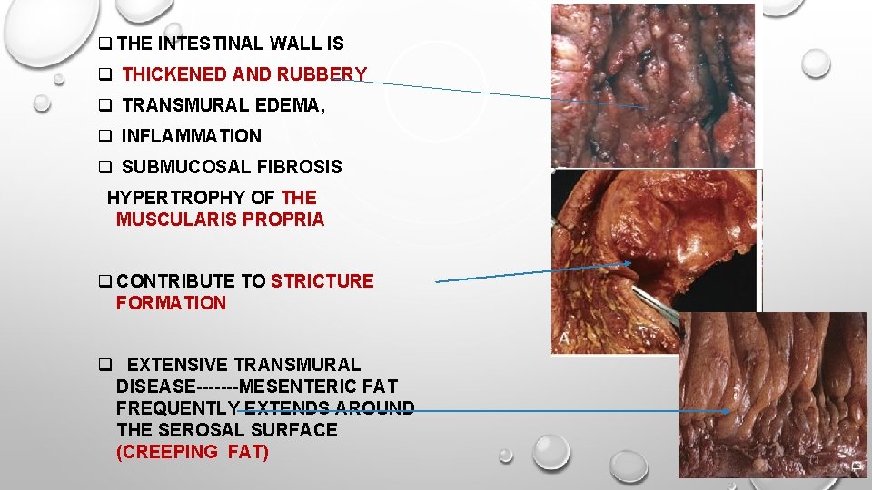 q THE INTESTINAL WALL IS q THICKENED AND RUBBERY q TRANSMURAL EDEMA, q INFLAMMATION