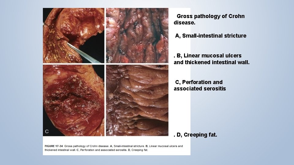  Gross pathology of Crohn disease. A, Small-intestinal stricture. B, Linear mucosal ulcers and