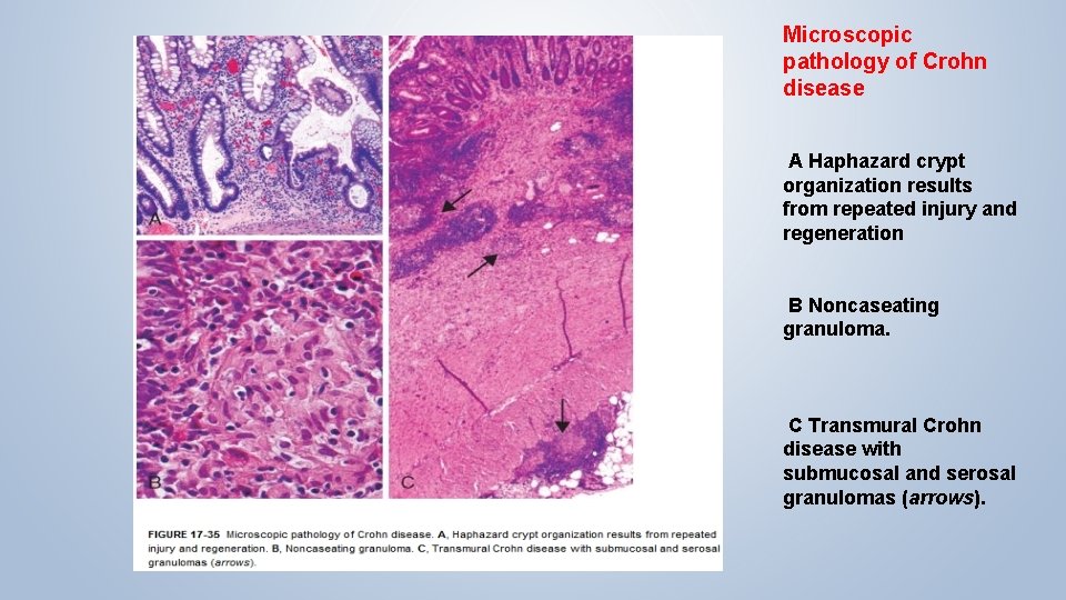 Microscopic pathology of Crohn disease A Haphazard crypt organization results from repeated injury and