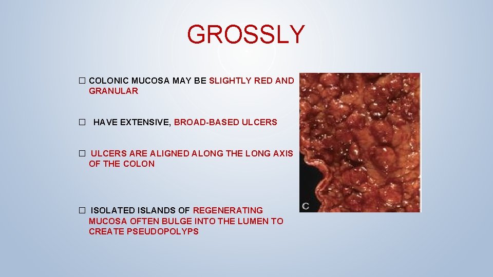 GROSSLY � COLONIC MUCOSA MAY BE SLIGHTLY RED AND GRANULAR � HAVE EXTENSIVE, BROAD-BASED
