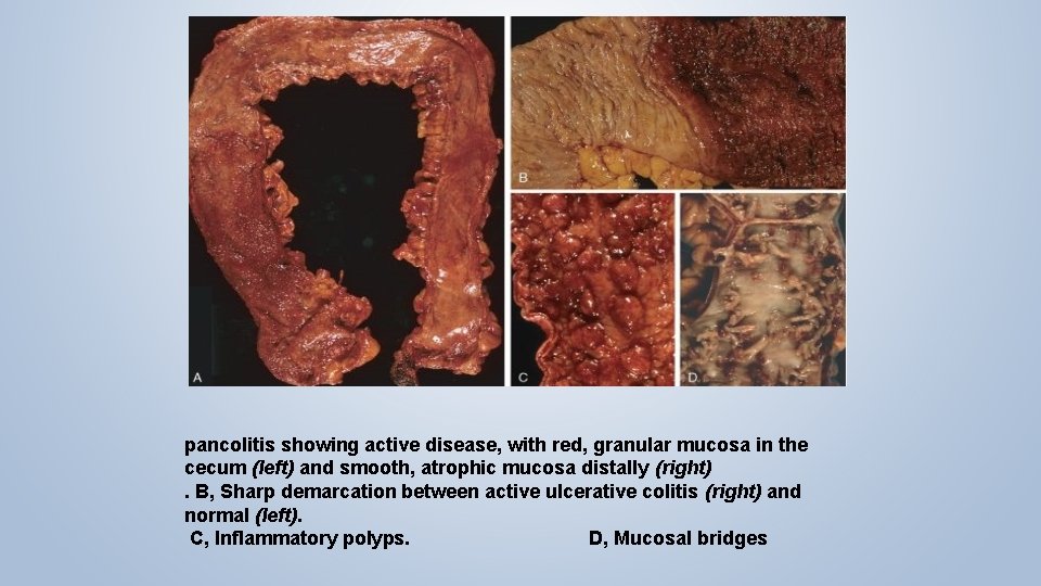 pancolitis showing active disease, with red, granular mucosa in the cecum (left) and smooth,