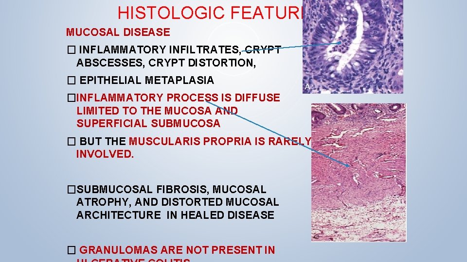 HISTOLOGIC FEATURES MUCOSAL DISEASE � INFLAMMATORY INFILTRATES, CRYPT ABSCESSES, CRYPT DISTORTION, � EPITHELIAL METAPLASIA