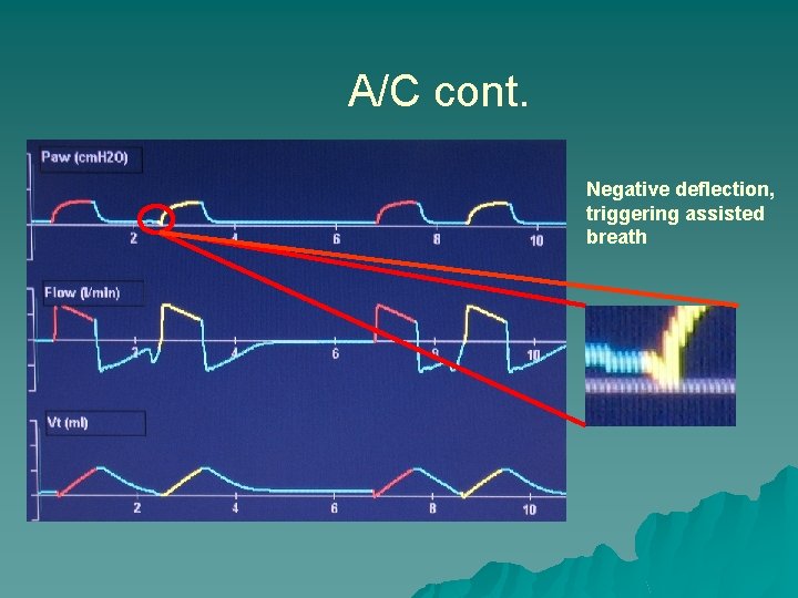 A/C cont. Negative deflection, triggering assisted breath 