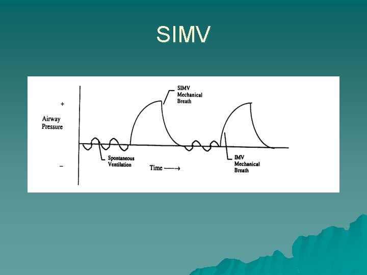 SIMV 