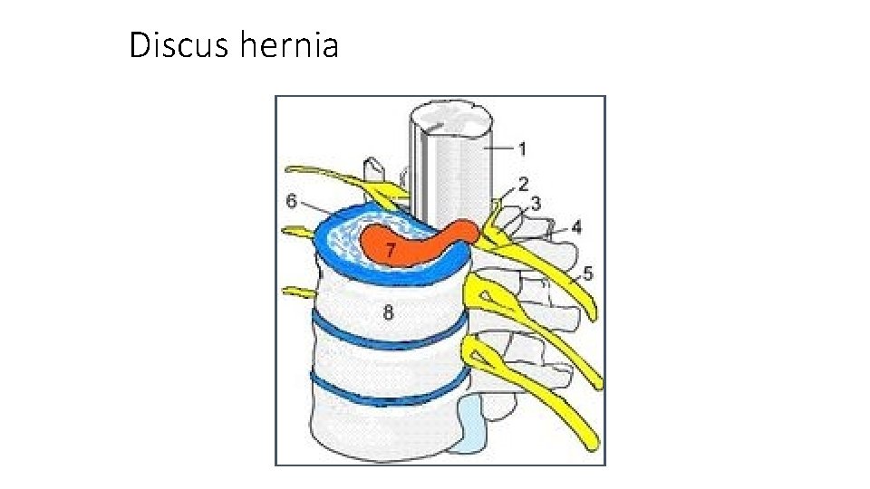 Discus hernia 