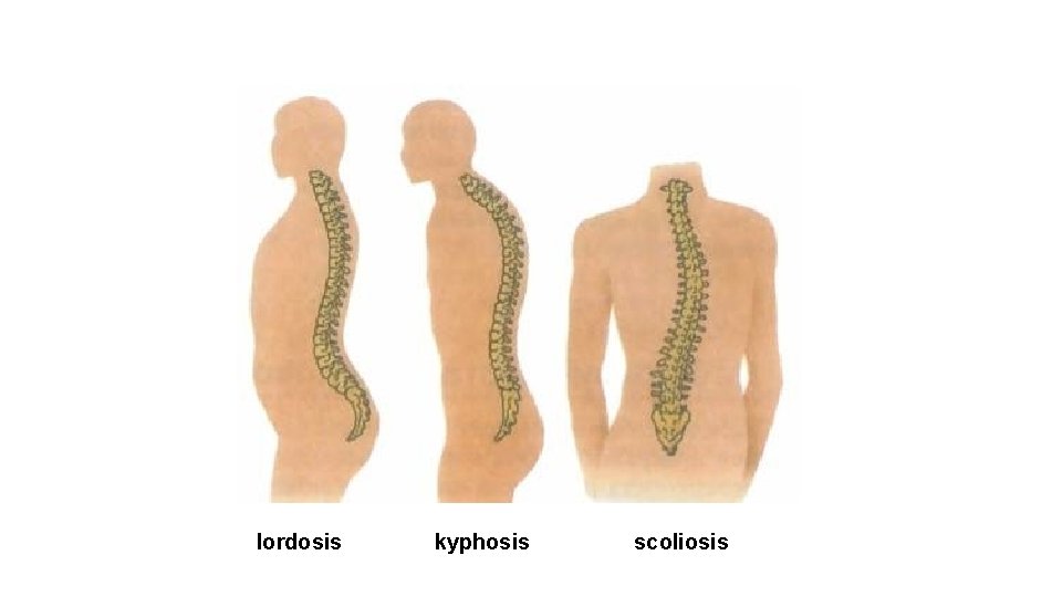 lordosis kyphosis scoliosis 