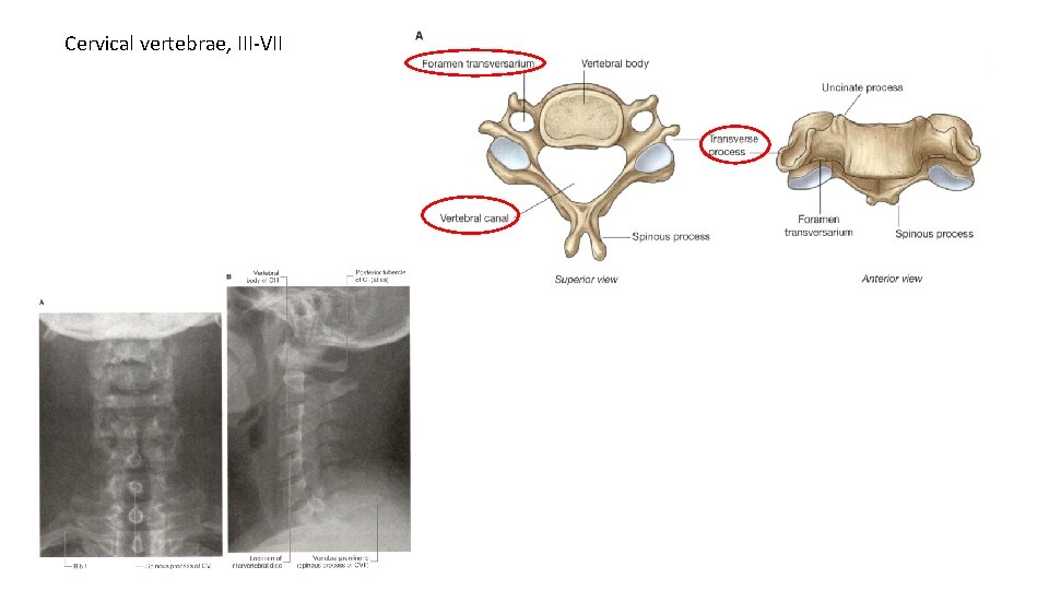 Cervical vertebrae, III-VII 