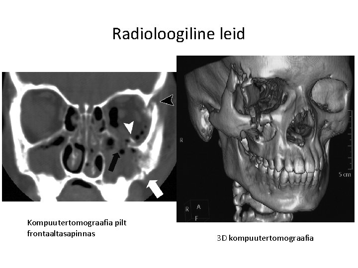 Radioloogiline leid Kompuutertomograafia pilt frontaaltasapinnas 3 D kompuutertomograafia 
