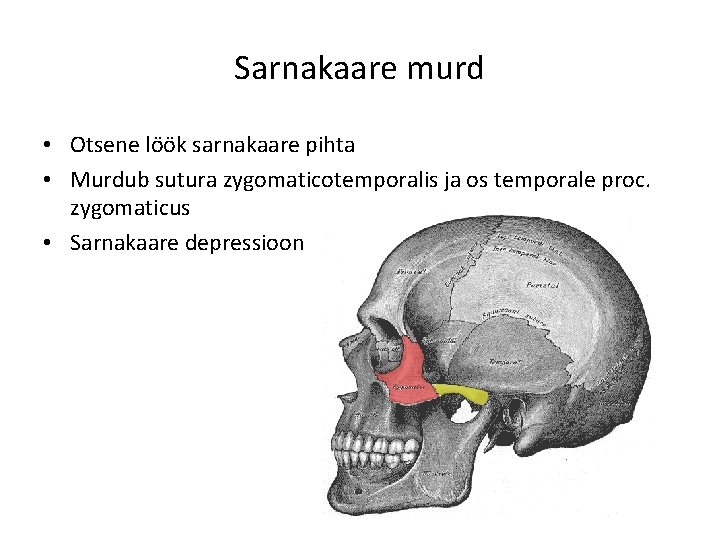 Sarnakaare murd • Otsene löök sarnakaare pihta • Murdub sutura zygomaticotemporalis ja os temporale