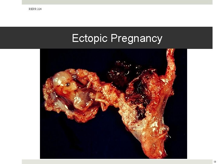 REPR 224 Ectopic Pregnancy 10 